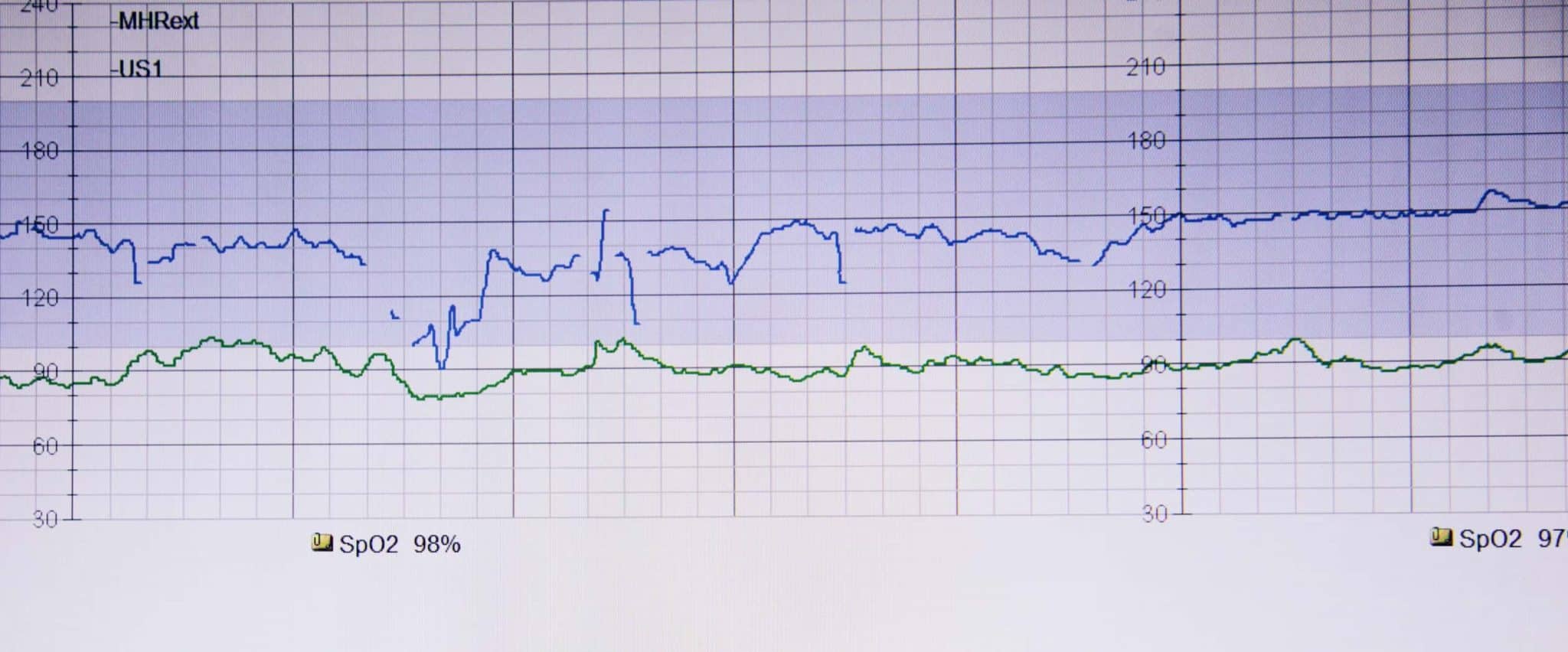 How to Improve Patient Outcomes with Data Mining in Healthcare